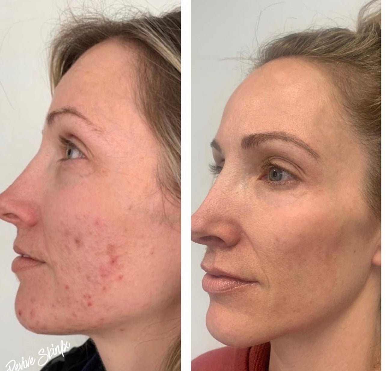 A Lamelle Chemical Peel With Microneedling in Claremont